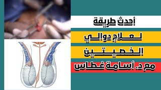 أحدث طريقة لعلاج دوالي الخصيتين بالجراحة الميكروسكوبية مع د. أسامة غطاس