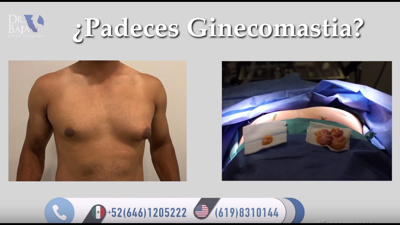 Hombres, ¿sufren de pechos grandes con grasa acumulada? ¡CUIDADO