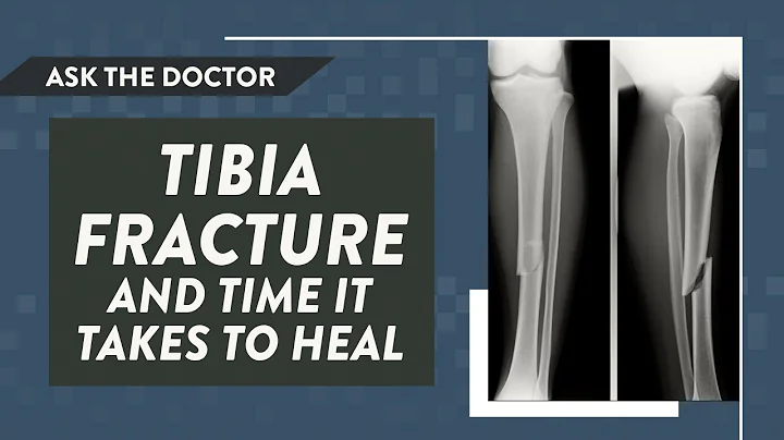Ask the Doctor: Tibia fracture and time it takes to heal