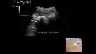 Ultrasound guided  facet joint injection, by Murat Karkucak MD