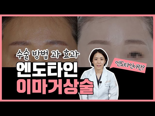 👶 10살은 어려지는 동안의 기적~? 엔도타인 이마거상술✨|동안성형|이마거상|엔도타인|수술방법|효과|