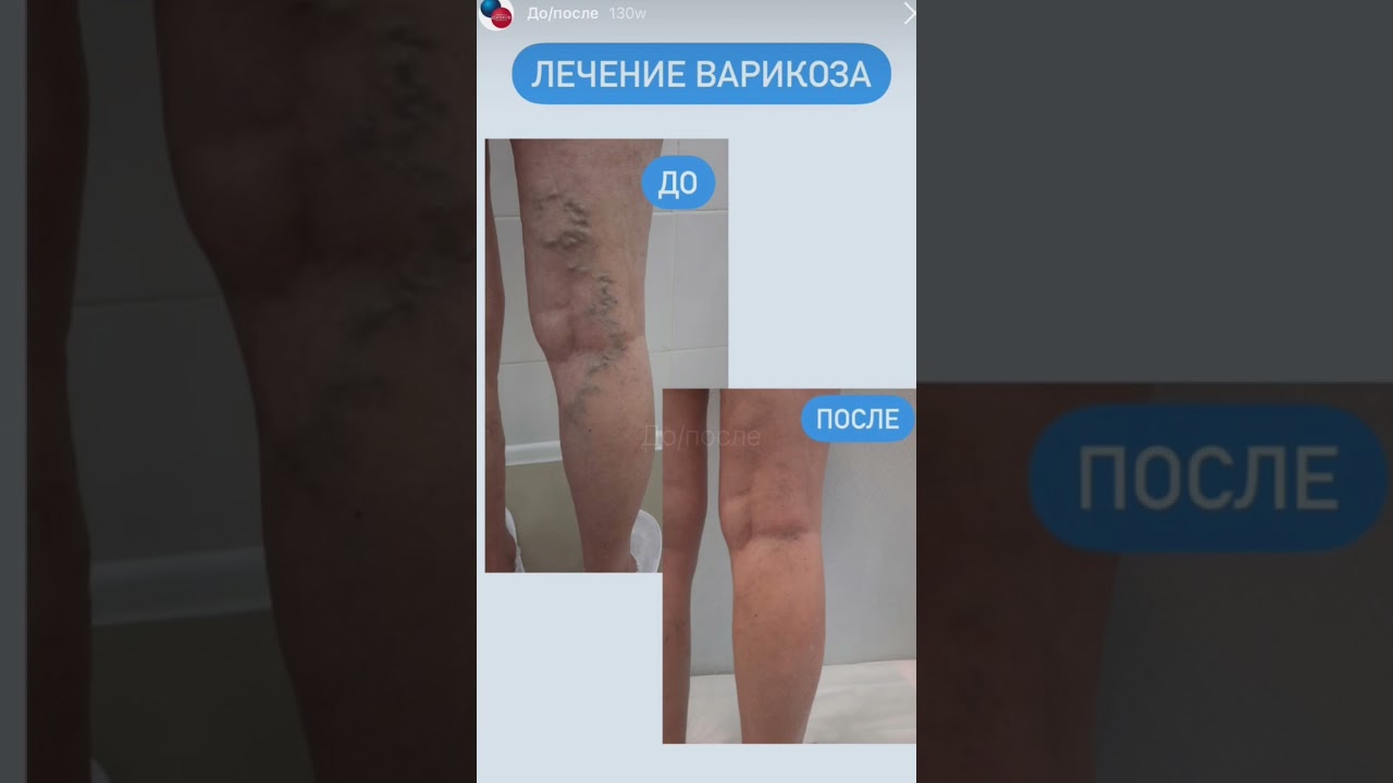 Клиника лечит варикоз, гангрены, инфаркты и многое другое. Подробнее на сайте angioclinic.ru