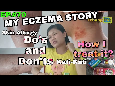 Video: Paano Magagamot ang Eczema sa paligid ng mga Mata (na may Mga Larawan)