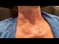 Dallas Mesotox for Crepey Neck and Chest by Dr. Lam