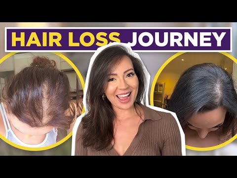 HAIR LOSS TREATMENT FOR WOMEN| MY FEMALE HAIR LOSS JOURNEY + TIPS ON HAIR LOSS