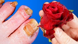 NAIL FUNGUS will disappear FOREVER if you use this Simple and Cheap method for 10 minutes a day!
