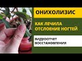 Онихолизис отслоение ногтевой пластины от ложа лечение как лечить