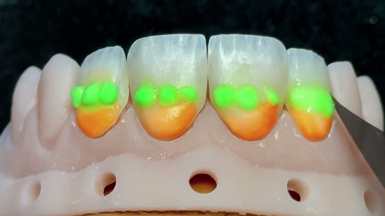 Aplicação de CERABIEN MiLai Luster em facetas de feldspato reforçadas com zircónio