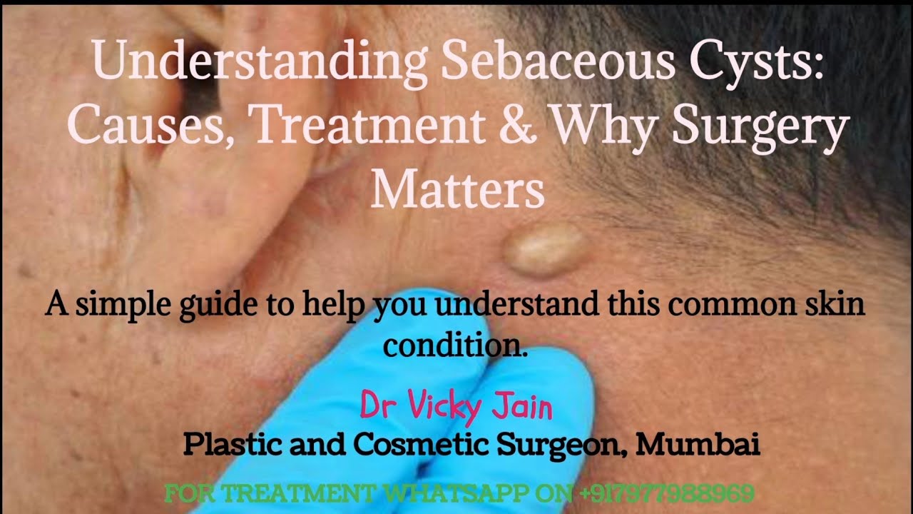 WHAT IS SEBACEOUS CYST -Should Your Sebaceous Cyst Be Removed by a Plastic Surgeon? | The Benefits