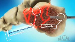 Ghost Productions - Medtronic - Inflatable Bone Tamp Marketing Reel