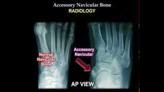 Accessory Navicular Bone  Everything You Need To Know  Dr. Nabil Ebraheim