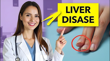 12 Signs of Liver Disease You Can See – Doctor Explains