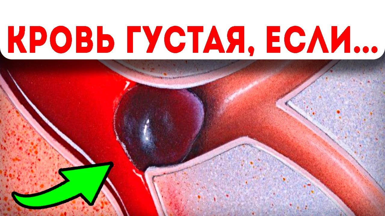 Как понять, что кровь густая? Тревожные признаки того, что пора ...