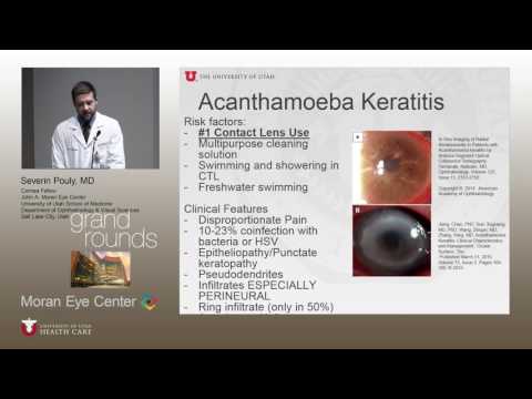 http://clinicaltrials.gov A Case of Acanthameoba Keratitis