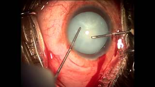 Capsulorhexis in intumescent cataract - 2 stage technique 2017 (HD)