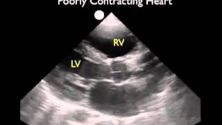 ультразвуковое исследование сердца  — парастернальная проекция по длинной оси — часть 2