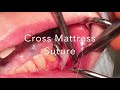 T Suture & Cross Mattress Suture