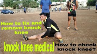 Indian army knock knee medical! कैसे चेक होता! how to remove and fix knock knee problems!6264212131
