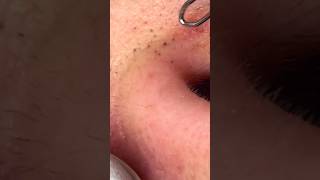 Blackheads