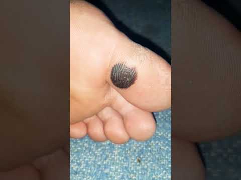 البقع السوداء في باطن القدم كيف تحدث