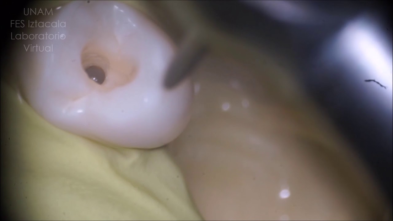 Cavidad de acceso del , Segundo Premolar superior