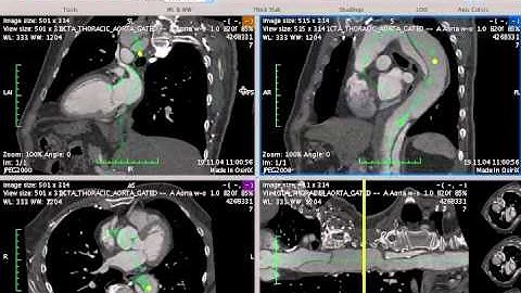 Aorta Segmentation in Curved MPR : Pre-Operative Measurements