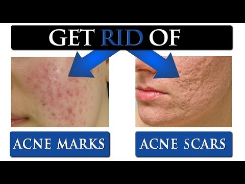 8 TIPS to get rid of ACNE SCARS & MARKS on your face