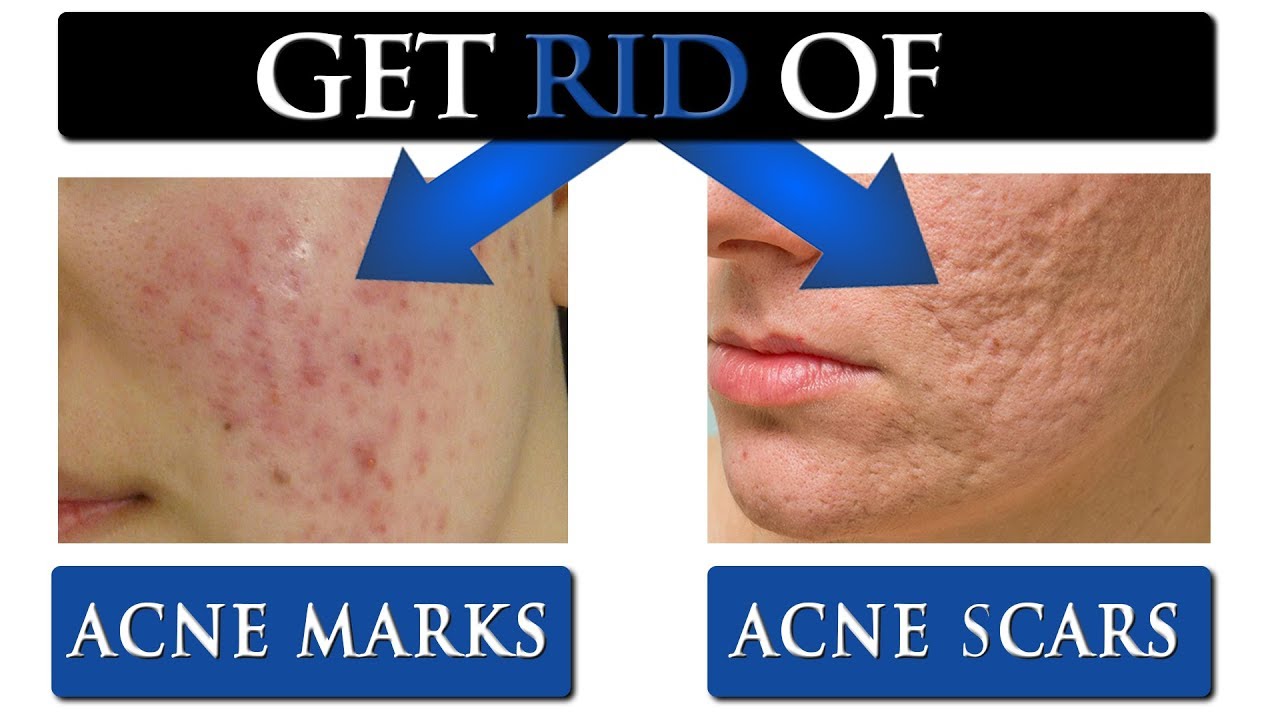 8 TIPS To Get Rid Of ACNE SCARS MARKS On Your Face