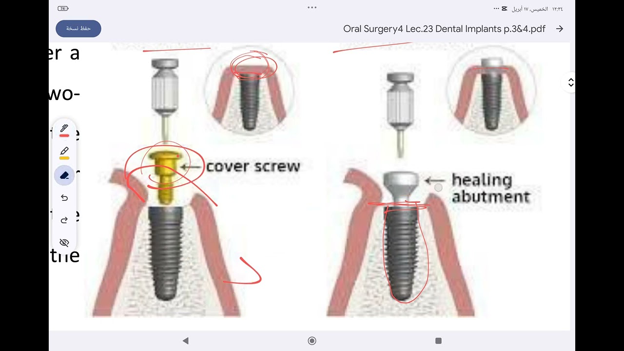 Oral surgery (Dental implant basic concept and techniques part 2 )