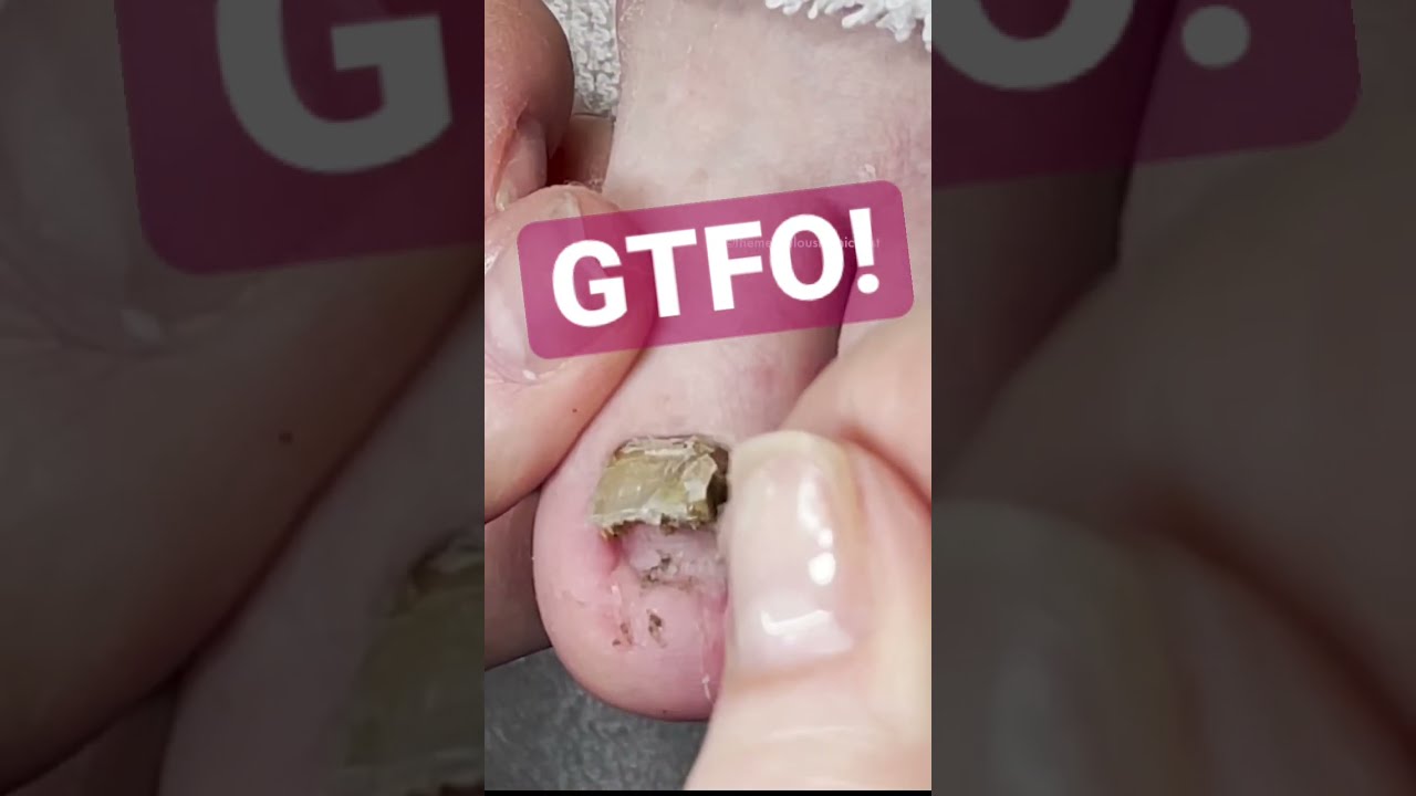 Get The Funk Out Cleaning Under Lifted Nail Meticulousmanicurist Gtfo Pedicure