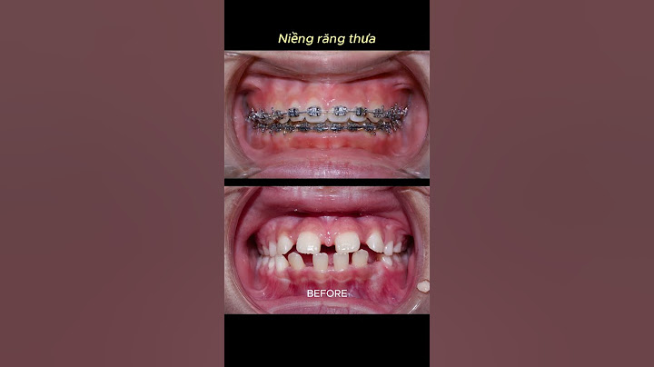 Braces process - Sparse teeth