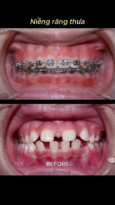 Braces process - Sparse teeth