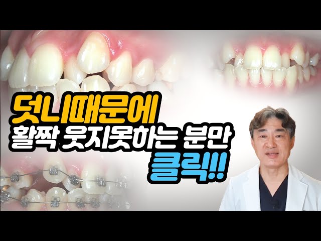 덧니치아교정으로 활짝웃음을 찾자! ft.돌출입덧니교정