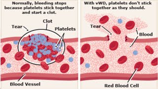 Von Willebrand disease