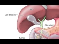 What is the Whipple Procedure - Mayo Clinic