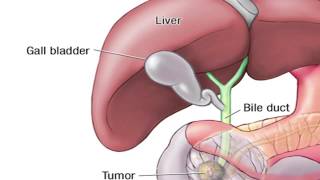 Dr. horacio asbun, mayo clinic in florida, explains the whipple
procedure using this animated graphic of a pancreas. cancer pancreas
affects 45,000 pe...