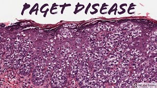 Extramammary Paget Disease: 5-Minute Pathology Pearls Extramammary Paget Disease: 5-Minute Pathology Pearls