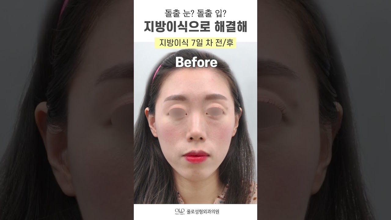 [奧露整形外科診所] #脂肪移植 #術前術後7天 真實呈現！活生生！ #凸嘴 #凸眼 皆能輕鬆解決~ #shorts
