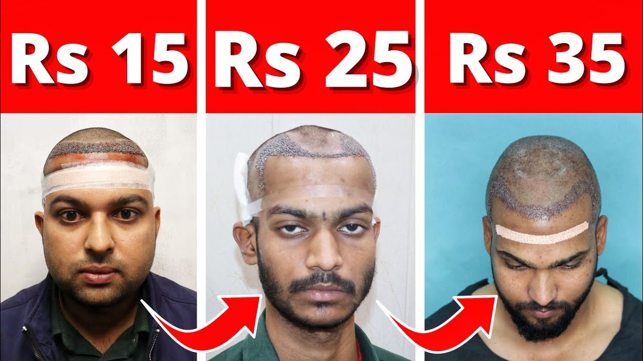 Hair Transplant Result Of Rs.15, Rs.25 and Rs.30 Per Grafts 🔥🔥🔥 Hair Transplant Cost In India 2025