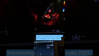 Transesophageal Echocardiography the Left Atrial Appendage is best visualized in mid-esophageal view