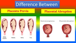 Differences between Placenta Previa and Placental Abruption