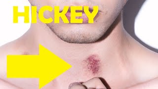 Celebrity how long does it take to get rid of a hickey Wealth