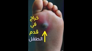 علاج الخراج _ الدمل