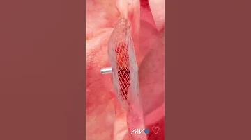 How Is A PFO Or Hole In The Heart Fixed 
