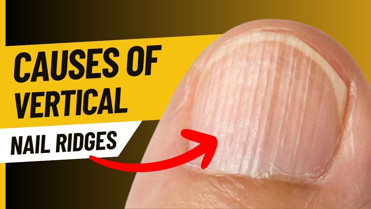 Common reasons that cause nail ridges - RSVP Live