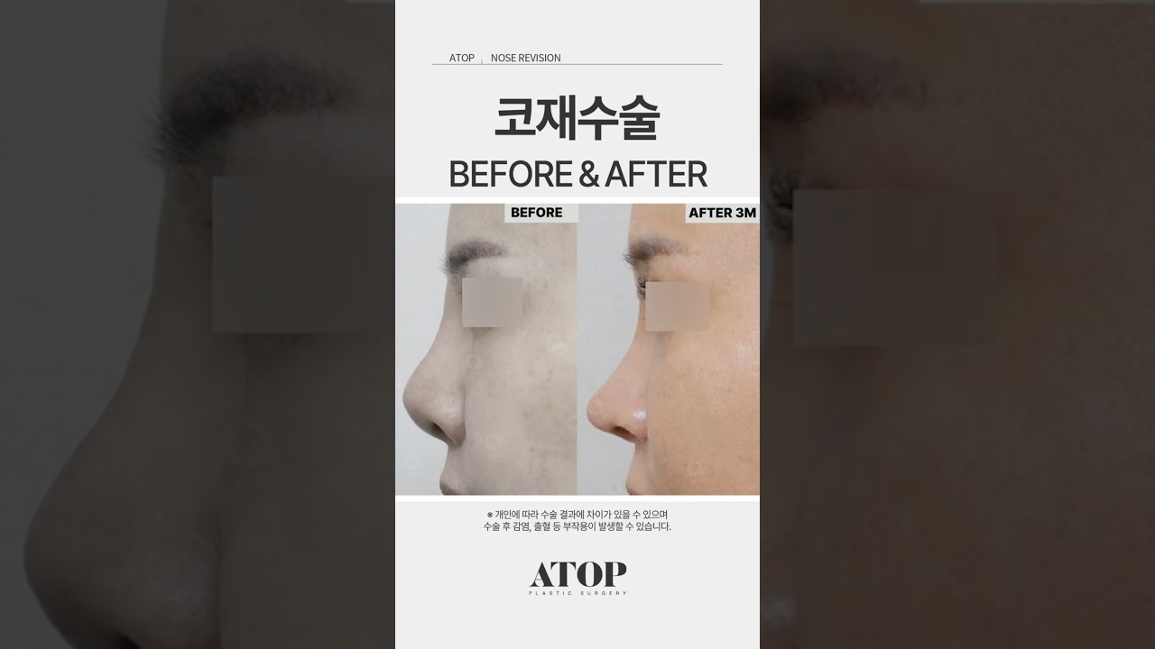 [Эйтоп гоо сайхны мэс заслын эмнэлэг] Хамар дахин заслын бодит сэтгэгдэл
#Эйтопгоосайхнымэсзаслынэмнэлэг #Хамардахинзасалсайнхийдэггазар #Хамардахинзаслынсэтгэгдэл