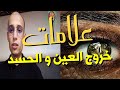 علامات خروج العين و الحسد من جسد المريض / الراقي المغربي زهير ادم