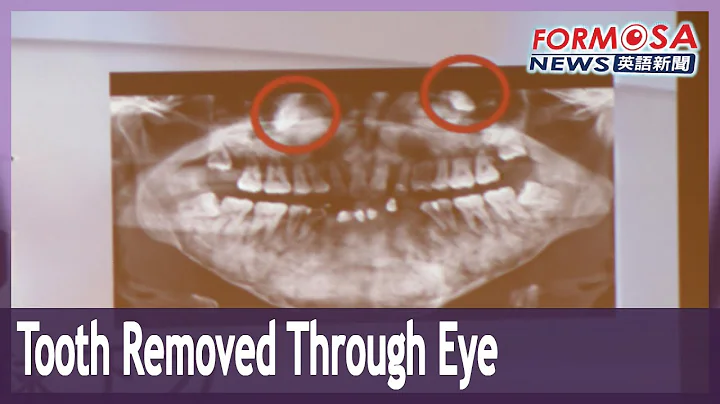 Taiwanese doctors complete first-ever removal of a tooth through the eye socket - DayDayNews