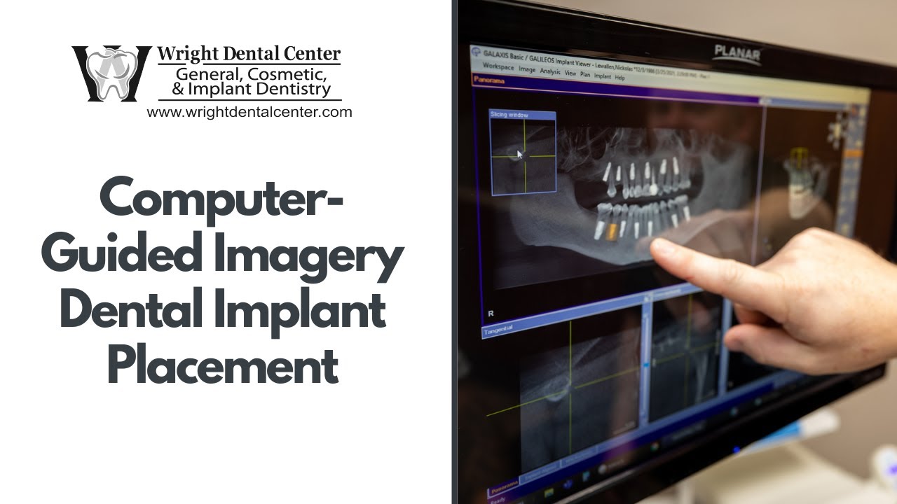 Computer-Guided Imagery For Precise Dental Implant Placement