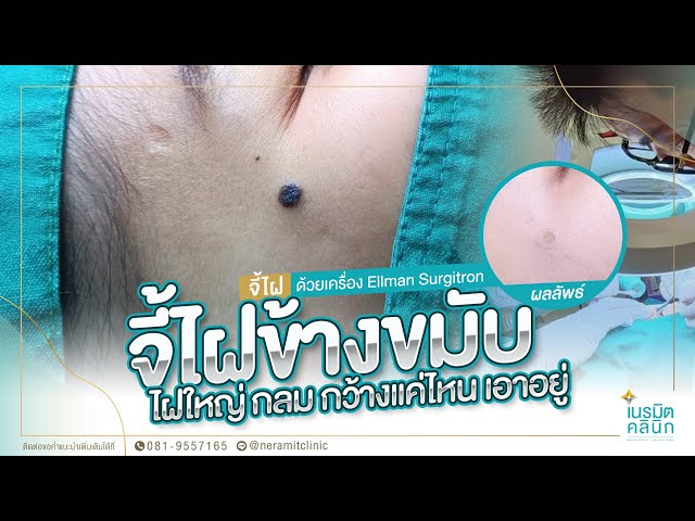 รีวิวตัดไฝ ขี้แมลงวัน EP.147/ไฝข้างขมับ ให้ระวังการใช้เงินเกินตัว @หมอปุ๊ NeramitClinic